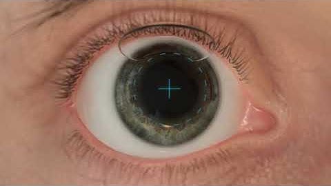 Behandeling met  Alcon excimer EX500