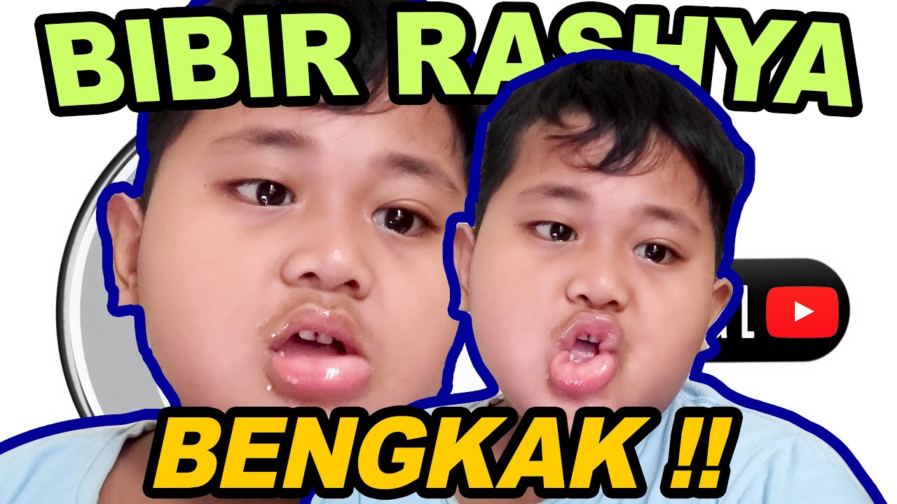 CARA MENGATASI BIBIR RASHYA BENGKAK AKIBAT DIGIGIT SERANGGA