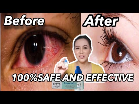 Mabisang pampatak sa namumulang mata or tired eyes |  Sparkling white eyes | JustMJ GARIN