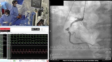 Shockwave IVL Live in a Box Case from Bristol Heart Institute