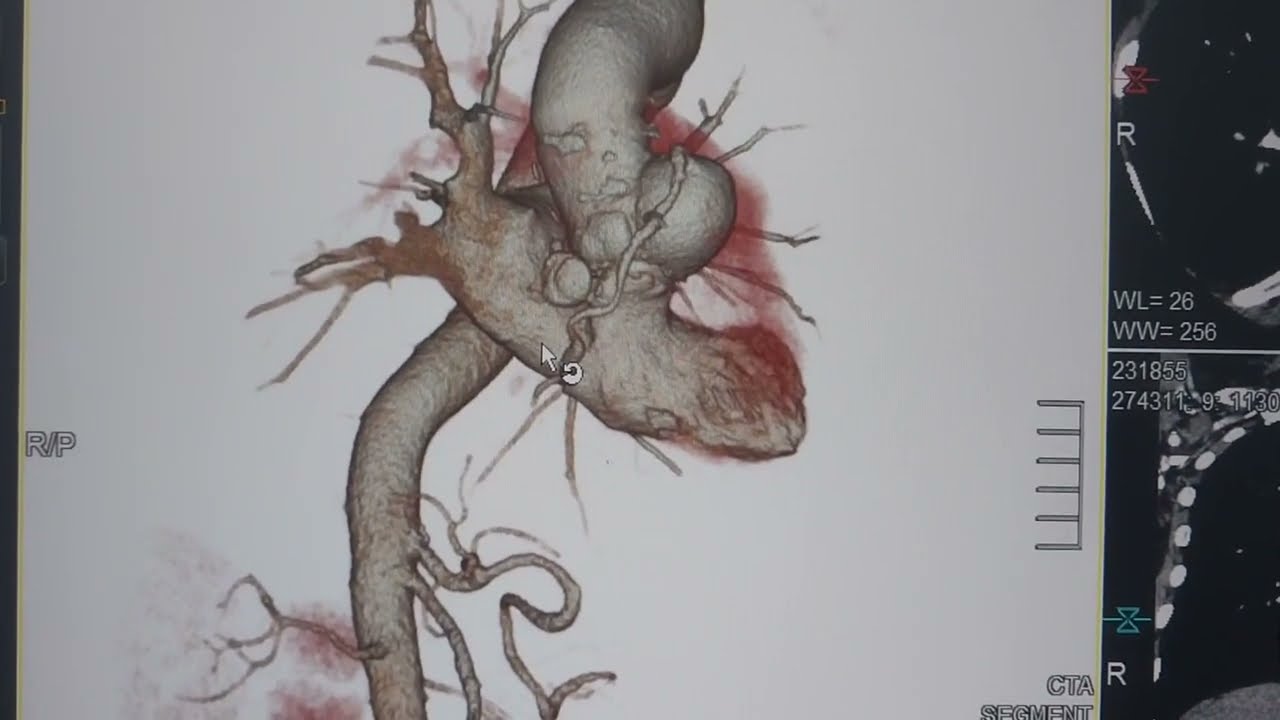 #CTA_AORTA مقطعيه ع شريان الاورطي الصدري الفحص به معلومات مهمه جدا نعتذر عن الخطاء في الفيديو السابق