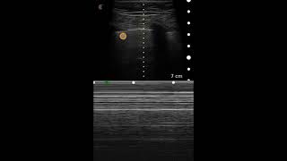 Pneumothorax Ultrasound Image Interpretation