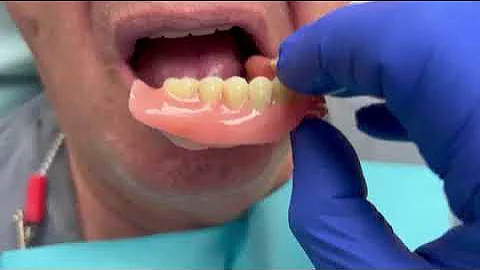 SUCTION Dentures (SEMCD) - Customized to every ridge & detail of your gums for a suction fit.