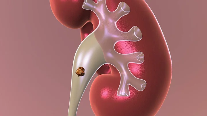 Observation: Non-surgical Approach to Kidney Stones - DayDayNews