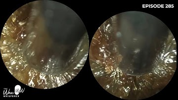 285 - Petrifying Ear Wax Removal using the WAXscope®️