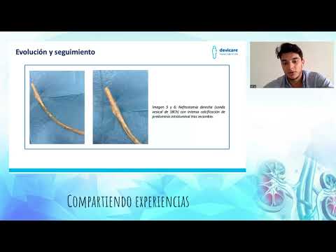 Acidificar la orina para prevenir la incrustación recurrente de catéteres dobleJ de larga duración. - video from Devicare