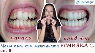 : 6     Invisalign -      
