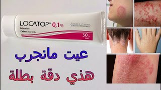 كريم Locatop دقة بطلة للحزاز الصدفية الأكزيما بلا ماضيعو الوقت جربوه