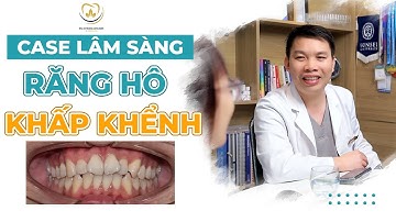 Trường Hợp Răng Hô Khấp Khểnh Nên Làm Gì | Bác sĩ Trung Long Biên
