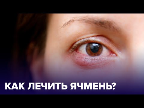 ЯЧМЕНЬ на глазу: как быстро ВЫЛЕЧИТЬ