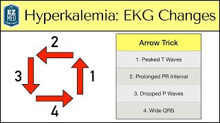 Hyperkalemia ECG Changes: EASY TRICK! [Mechanism Explained]