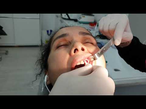 Vidéo: Cholisal Dental - Mode D'emploi Du Gel Dentaire, Prix