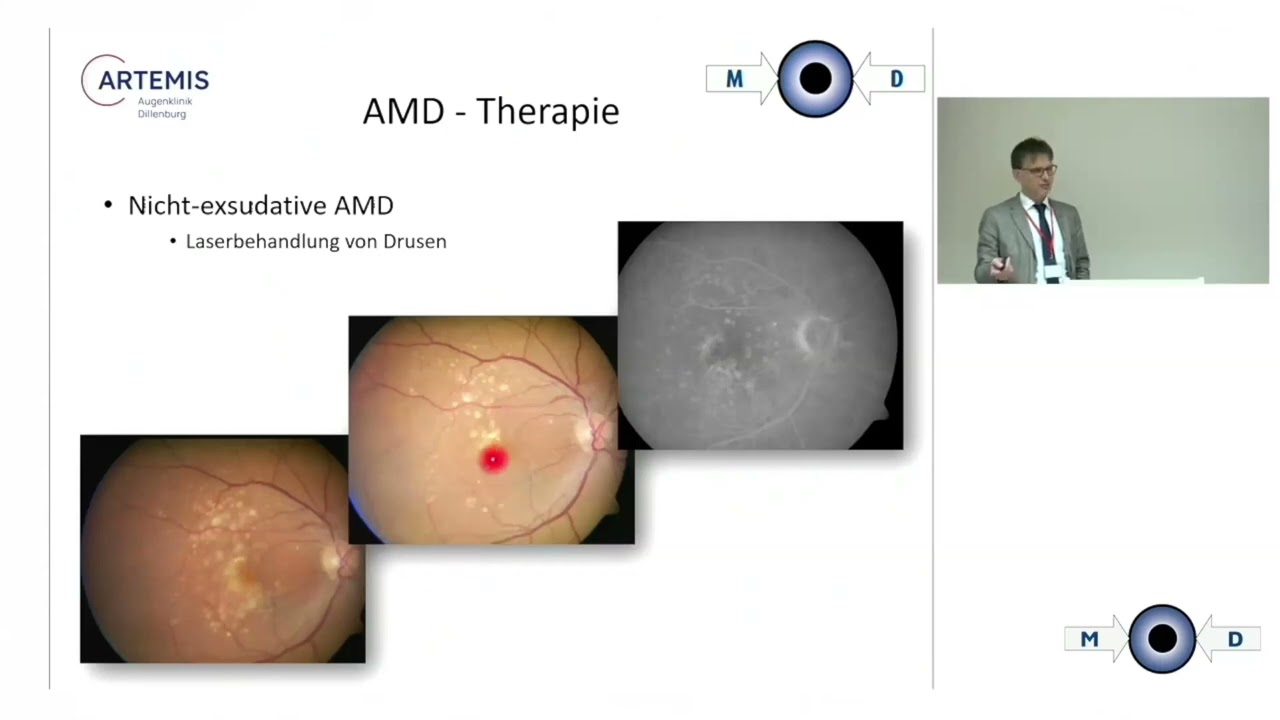 Dr. Steffen Hörle: Photobiomodulation bei trockener AMD Sinvoll? Disput: Pro MOD 2022