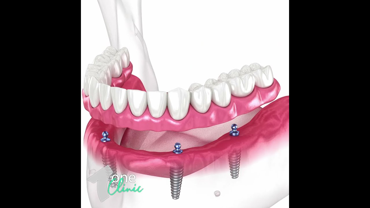 Jaw Implant All In 4 