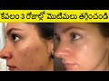 How To Get Rid Of Pimples Naturally at Home in 3 Days Explained in Telugu | Pimples Home Remedies