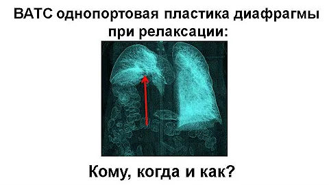 ВАТС однопортовая пластика диафрагмы при релаксации: кому, когда и как? (Базаров Д.В., РНЦХ)