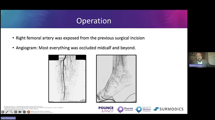 Dr. Kevin Onofrey Discusses Limb Salvage Using the Pounce™ LP Thrombectomy System