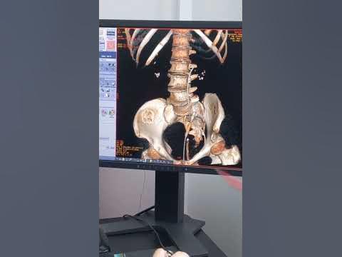 КТ почек | 3D| компьютерная томография почек - YouTube