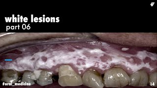 white lesions || lichen planus 1 || oral medicine _ عزت شومان