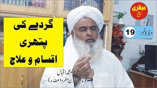 Kidny Ston ● Video 19 ● Gurday ki Pathri ● گردے کی پتھری ● पथरी ● Ubqari