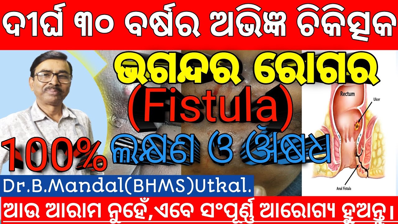 ଭଗନ୍ଦର ରୋଗର ଲକ୍ଷଣ ଓ ଔଷଧ। Best Homoeopathic Medicine for Fistula by 30years experience Dr. B.Mandal.