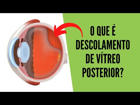 Vídeo: Descolamento Vítreo Posterior: Causas, Sintomas E Muito Mais