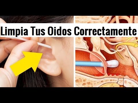 Como quitar el tapon del oido