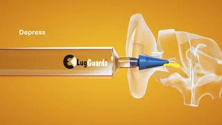 A quick demonstration of the how our LugGuards tip is used to treat wax blockages effectively.