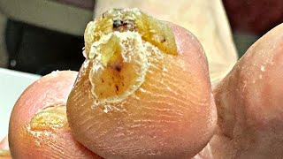 DEEP Corn Removal On Tip Of The Toe!