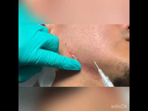 How to Perform a Steroid Injection Into a Keloid