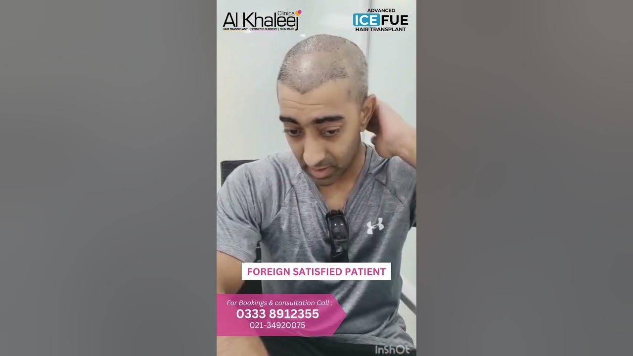 satisfied-foreign-patient-ice-fue-hair-transplant-youtube