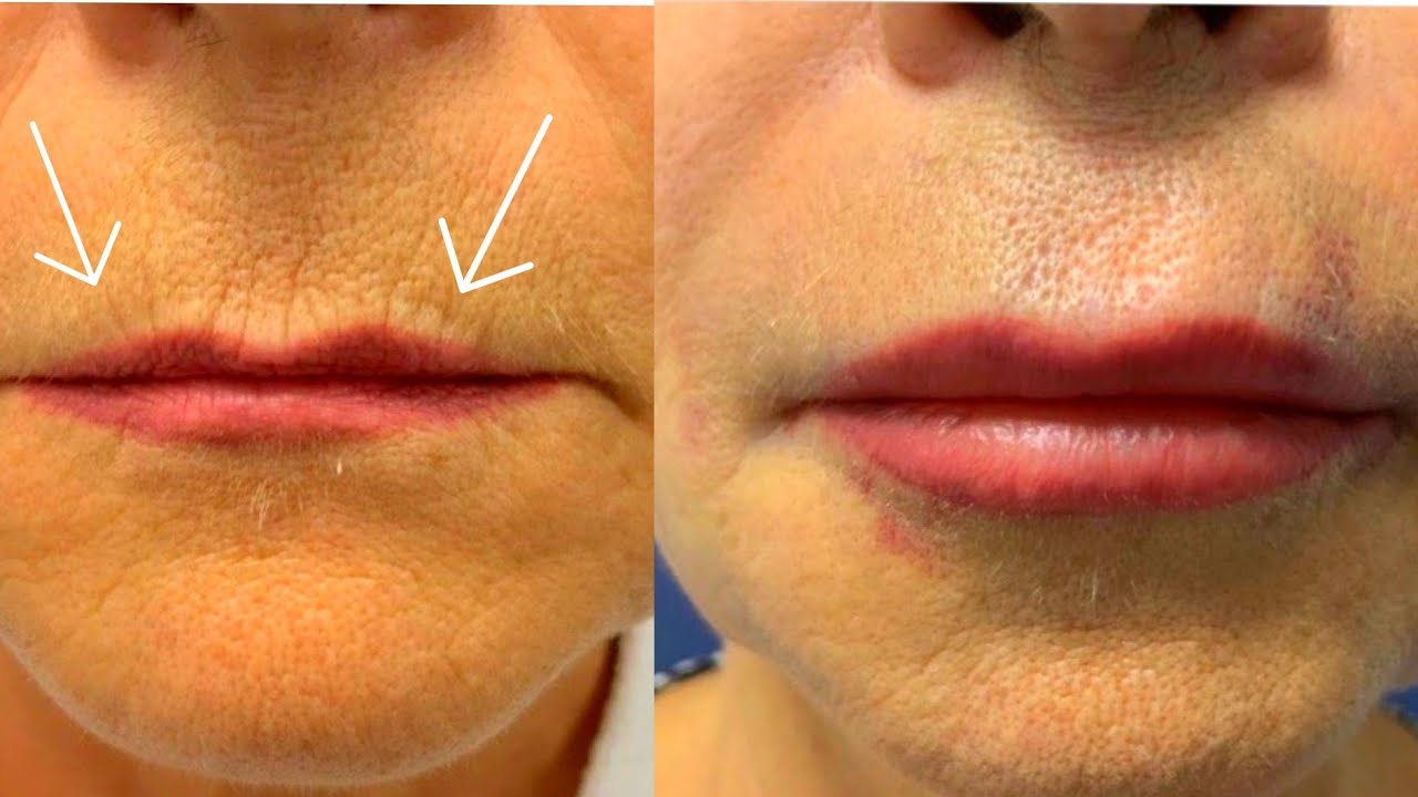 Top Techniques for Cheek Lift Surgery | Taban MD - Blog