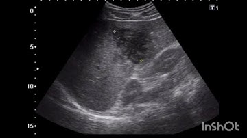 Understanding Pyogenic Liver Abscess Through Ultrasound Imaging