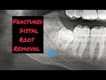 Fractured root removal molar extraction