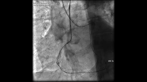 Aortic dissection and radial rupture during retrograde CTO PCI: Management of complications VİDEO 18