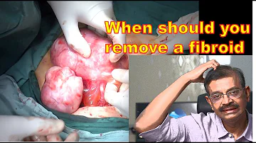 What happens if you don't remove fibroids?