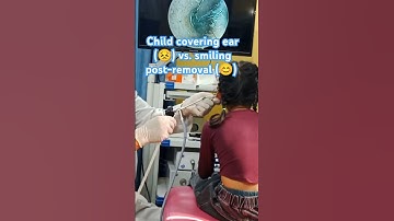 My Daughter’s *HUGE* Earwax Plug! 👶👂 (ENT Doctor’s Satisfying Removal) #EarWax #Satisfying