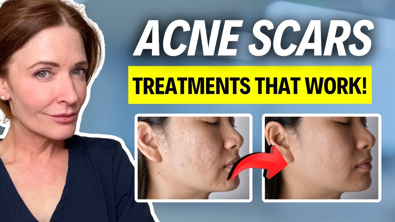 Do This for Acne Scars!
