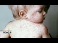Nebraskans Encouraged to Stay Protected Against Measles