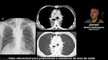 O que é pneumonite alergica sintomas?