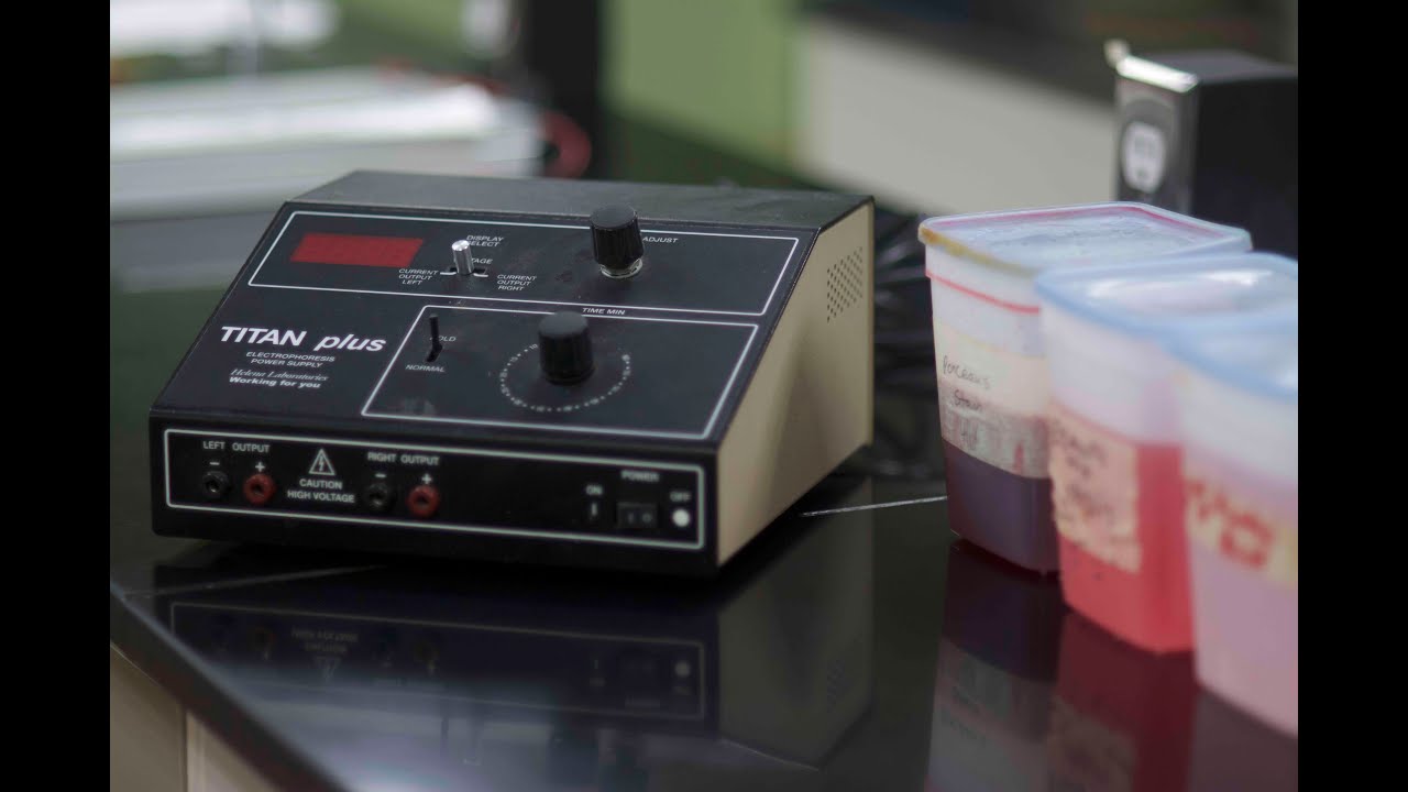 SERUM PROTEIN ELECTROPHORESIS YouTube