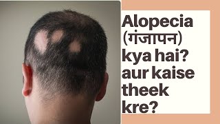 What is Alopecia I Solution of Alopecia I Alopecia