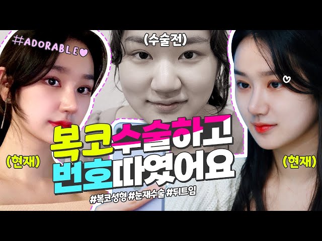 복코수술+눈재수술로 리즈미모 갱신한 썰!!     #복코 #눈재수술 #심부볼