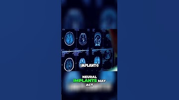 Brain Implants: Are We Tuning In, or Just Turning On?