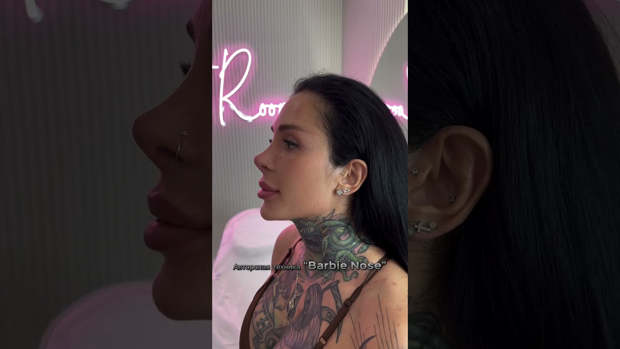 Non-Surgical Rhinoplasty: Achieving a Beautiful "Barbie Nose" with Our Author’s Method