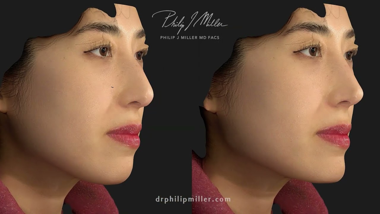 Vectra 3D Virtual Consultation At Dr. Philip Miller's NYC Office