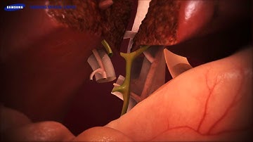 간이식[3D Medical Contents]