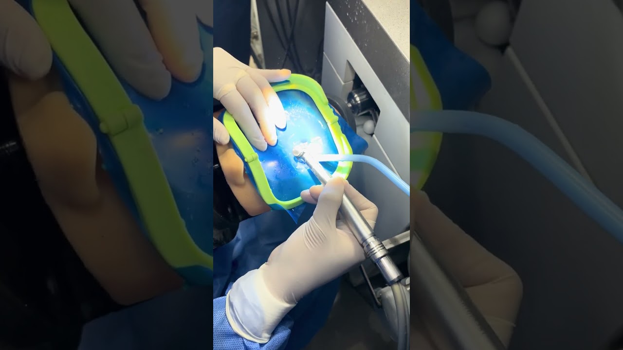 INCRUSTACIÓN ODONTOPEDIATRIA