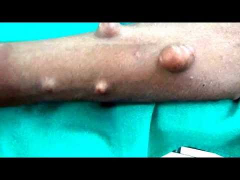 Neurofibromatosis | Multiple swellings on the body | शरीर में अनेक गांठ