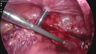 perforated appendix with pelvic abscess laparoscopic pelvic abscess drainage and appendicectomy